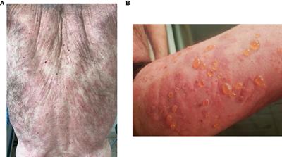 Biological treatment for bullous pemphigoid